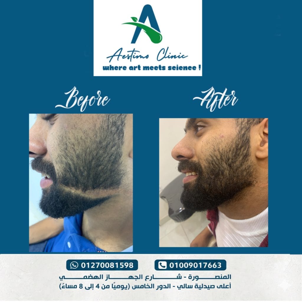 زراعة-شعر-قبل-وبعد-المنصورة-دكتور-طارق