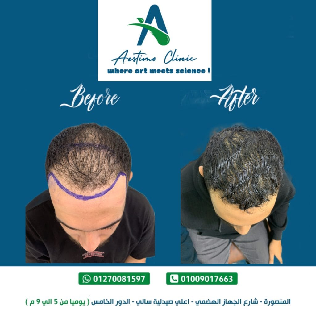 نتيجة زراعه شعر في المنصورة مع د طارق احمد