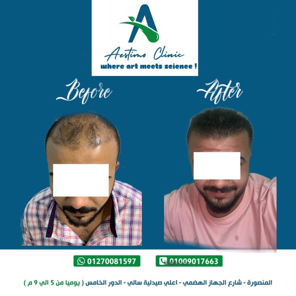 زراعة الشعر في المنصورة