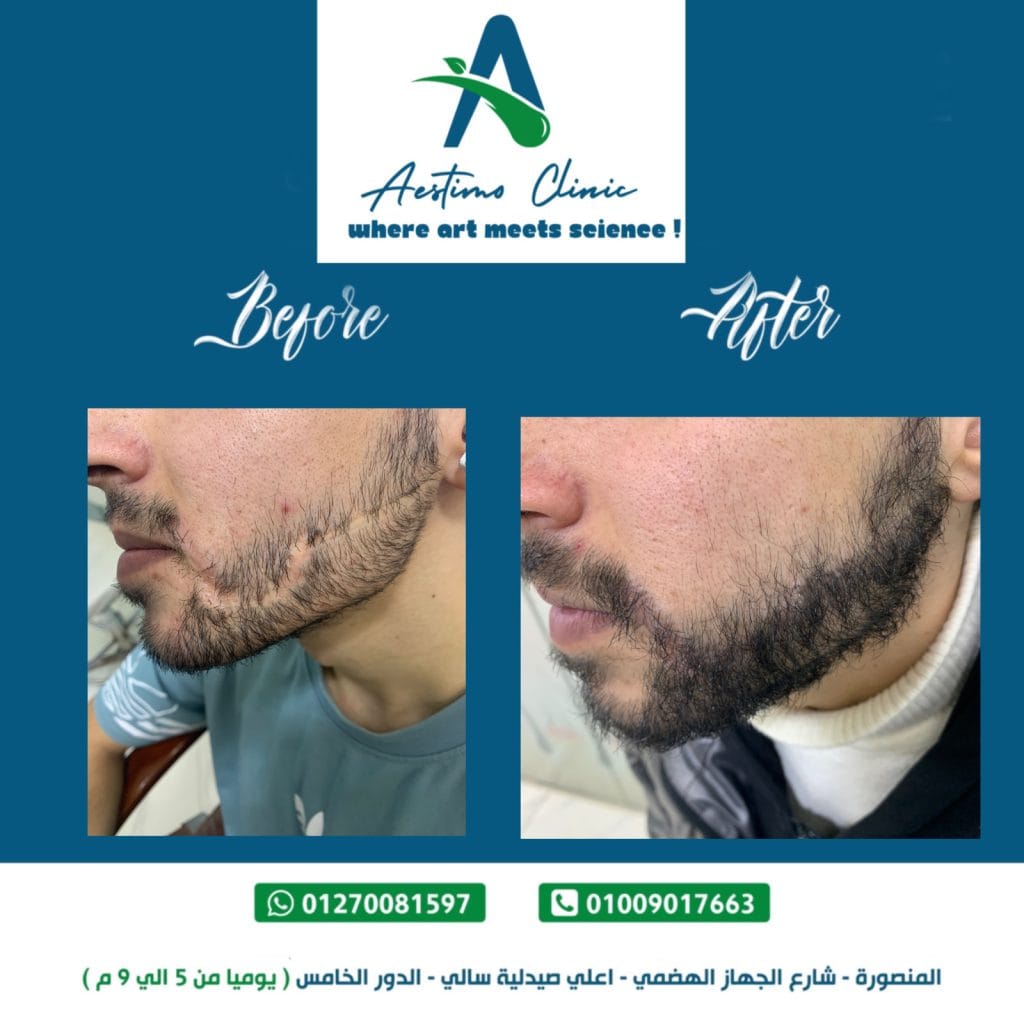 زراعة جرح في الشعر في الوجه في المنصورة