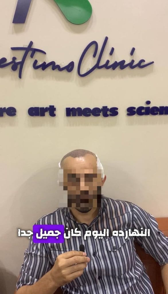 زراعة-شعر-قبل-وبعد-المنصورة-دكتور-طارق