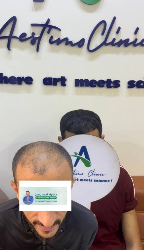 زراعة-شعر-قبل-وبعد-المنصورة-دكتور-طارق