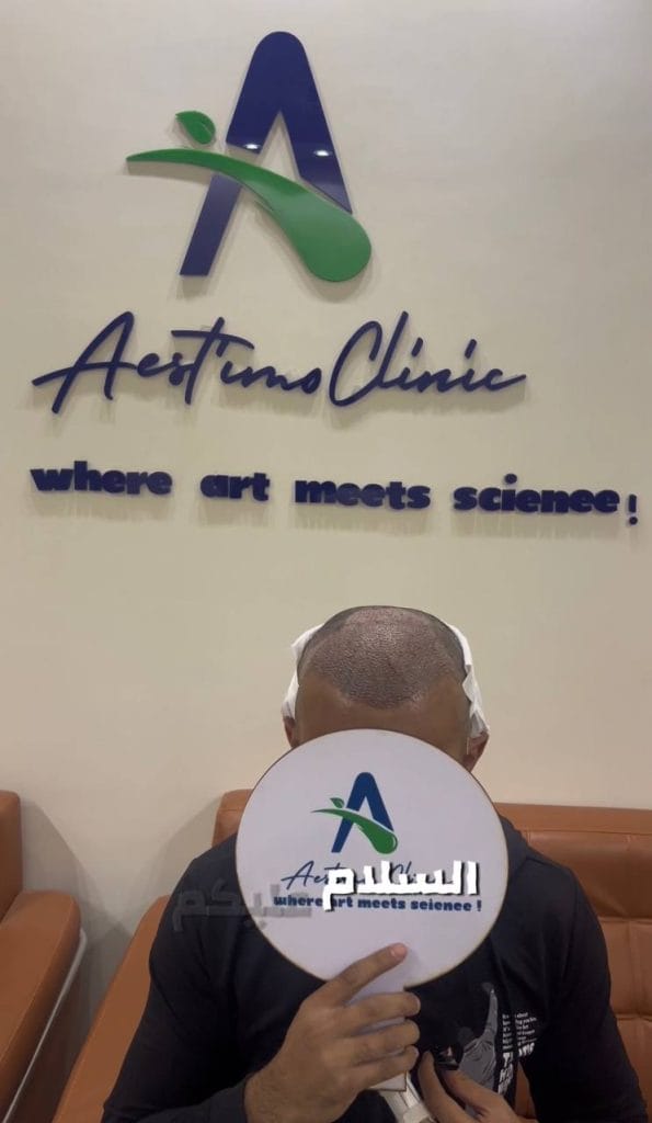 زراعة-شعر-قبل-وبعد-المنصورة-دكتور-طارق