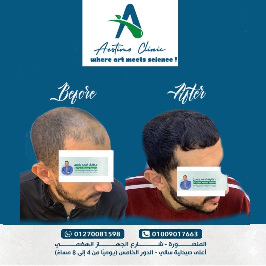 زراعة-شعر-قبل-وبعد-المنصورة-دكتور-طارق