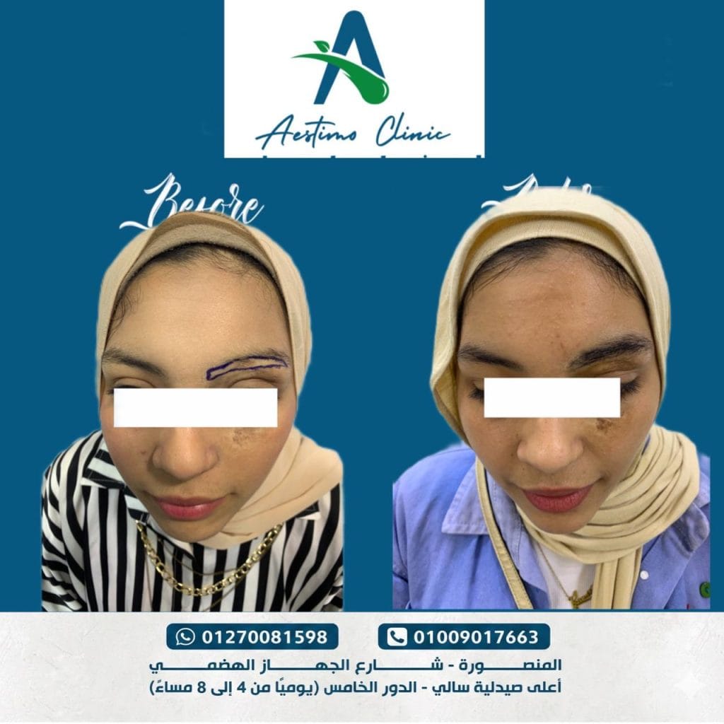 زراعة الحواجب في المنصورة