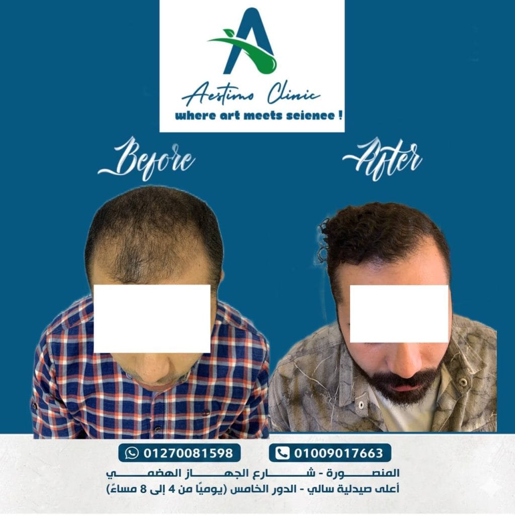 زراعة-شعر-قبل-وبعد-المنصورة-دكتور-طارق