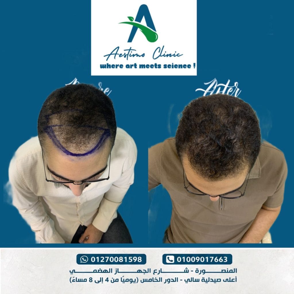 زراعة-شعر-قبل-وبعد-المنصورة-دكتور-طارق