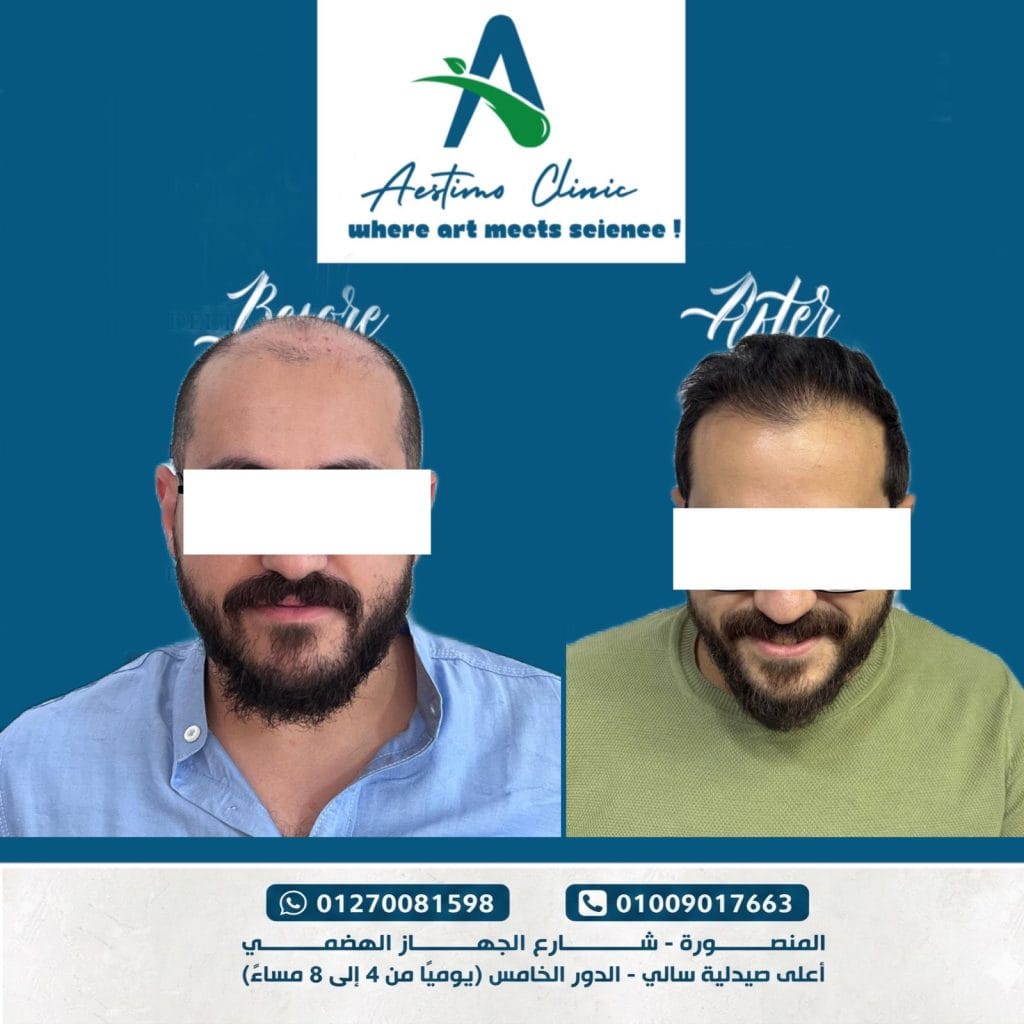 زراعة-شعر-قبل-وبعد-المنصورة-دكتور-طارق