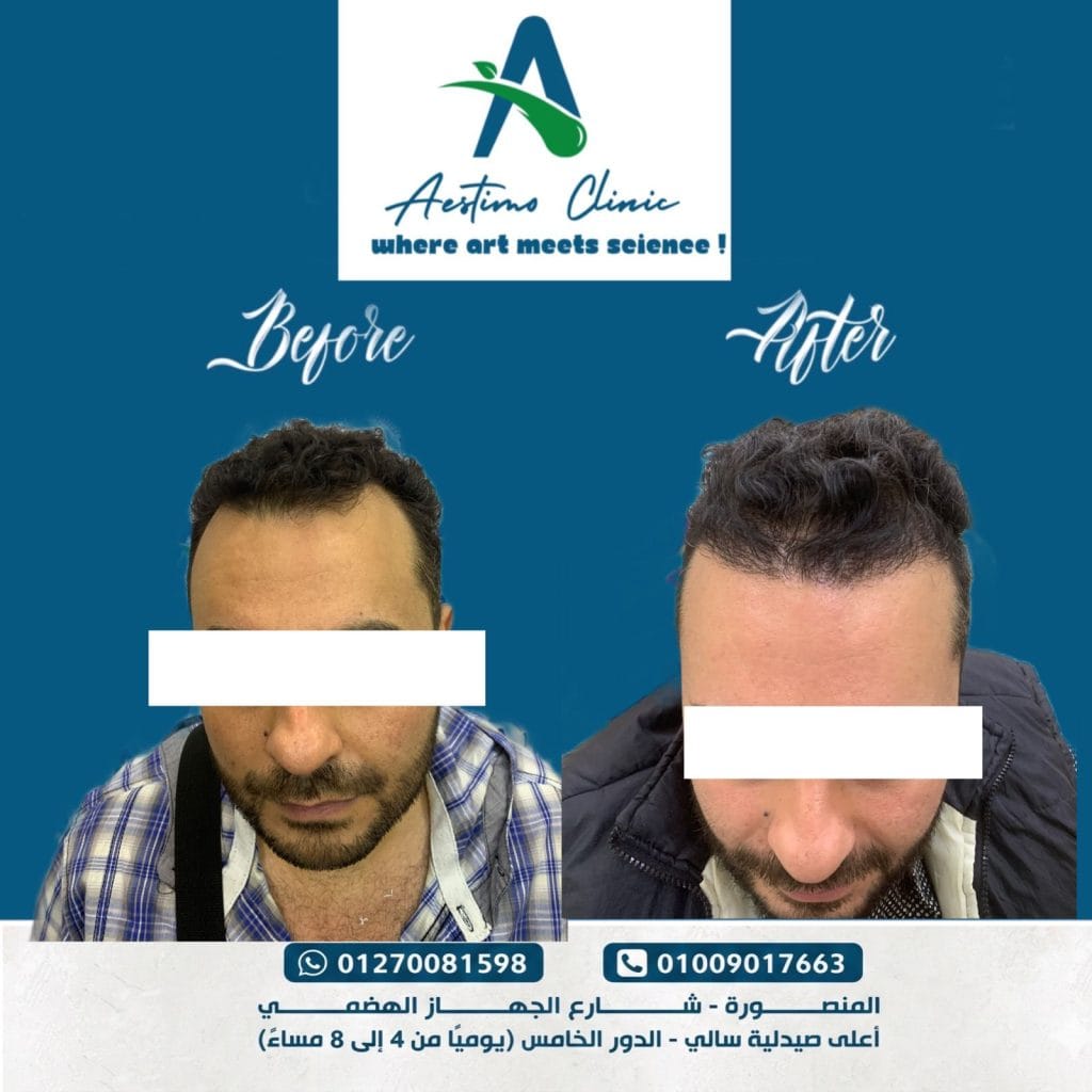 زراعة-شعر-قبل-وبعد-المنصورة-دكتور-طارق