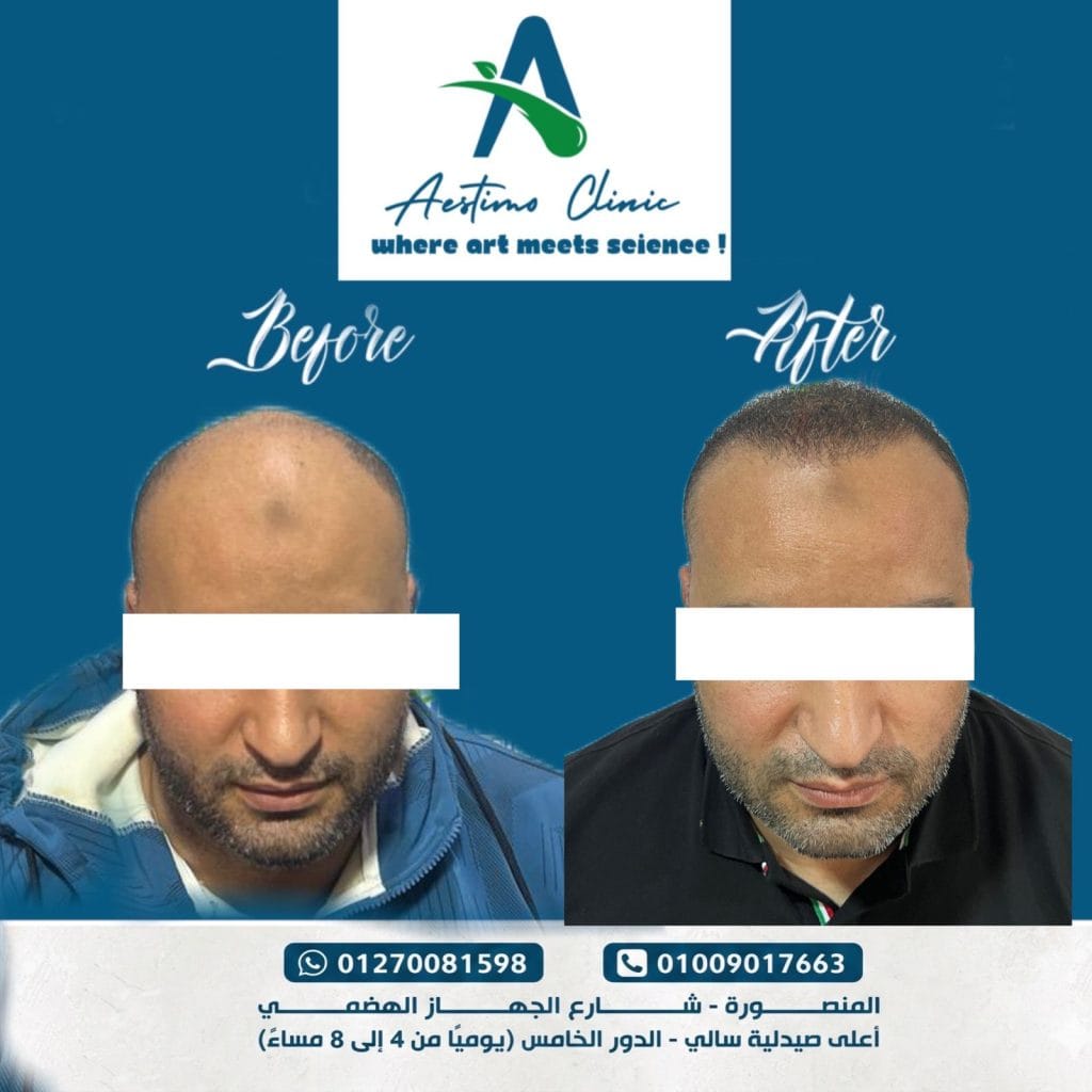 زراعة-شعر-قبل-وبعد-المنصورة-دكتور-طارق