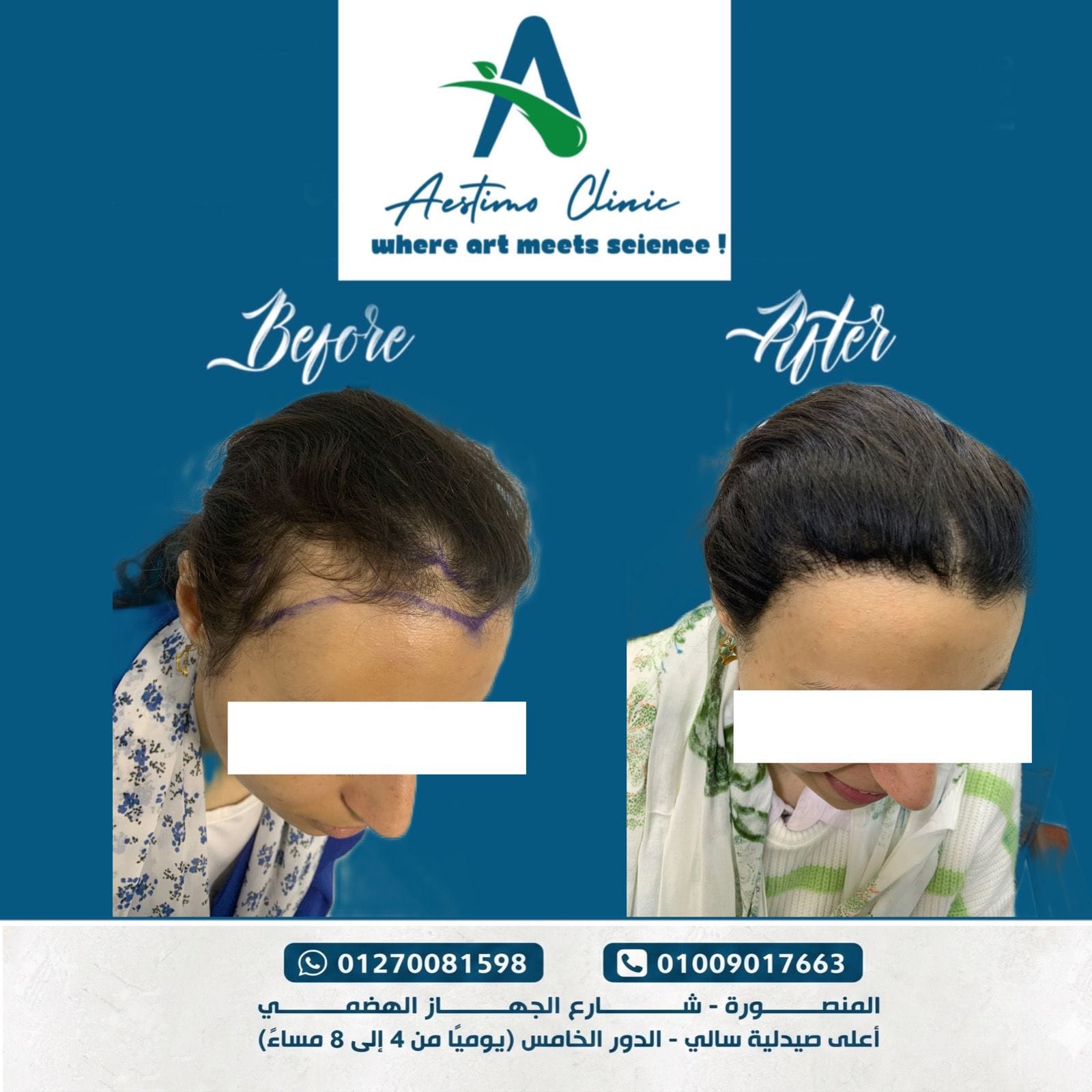 زراعة-شعر-قبل-وبعد-المنصورة-دكتور-طارق