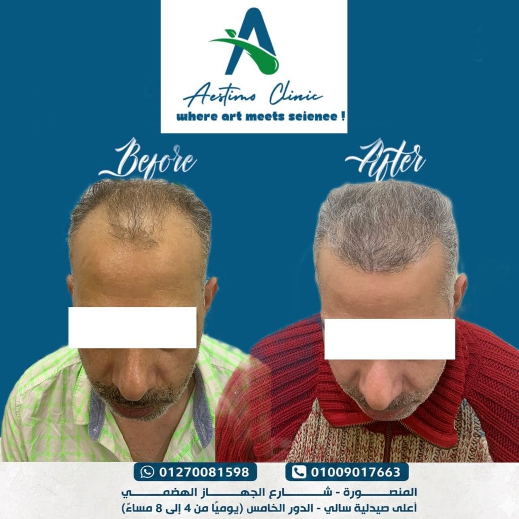 زراعة-شعر-قبل-وبعد-المنصورة-دكتور-طارق