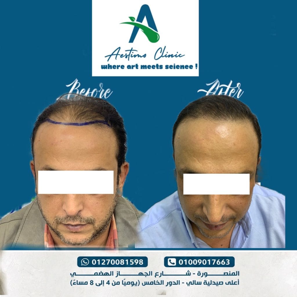 زراعة-شعر-قبل-وبعد-المنصورة-دكتور-طارق