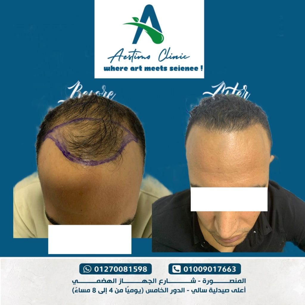 زراعة-شعر-قبل-وبعد-المنصورة-دكتور-طارق