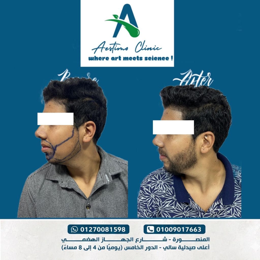 زراعة-شعر-قبل-وبعد-المنصورة-دكتور-طارق