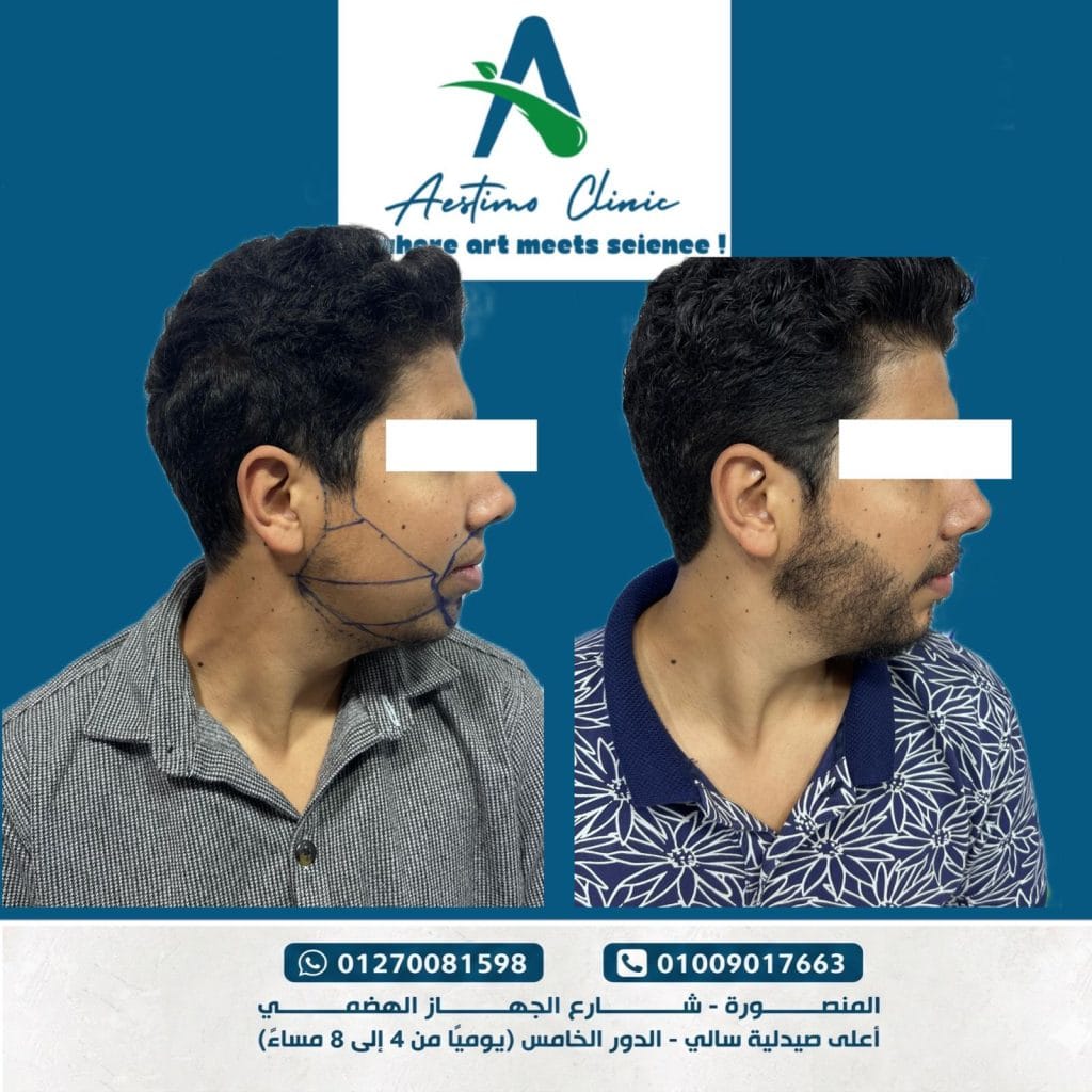 زراعة الشعر في المنصورة7