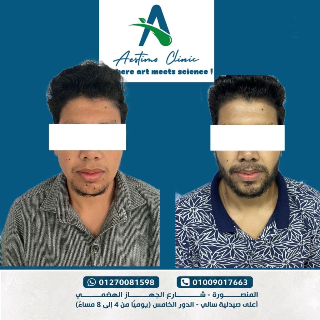 زراعة شعر الذقن في المنصورة