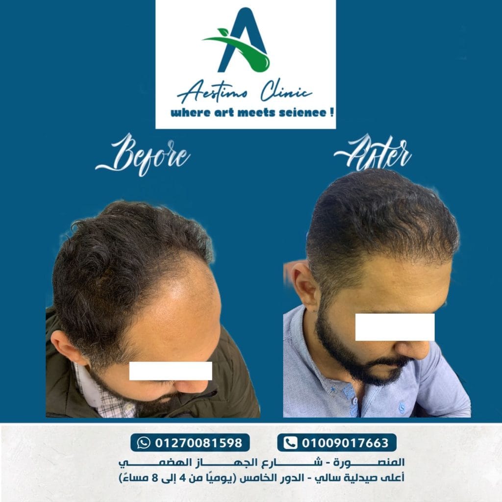 زراعة-شعر-قبل-وبعد-المنصورة-دكتور-طارق