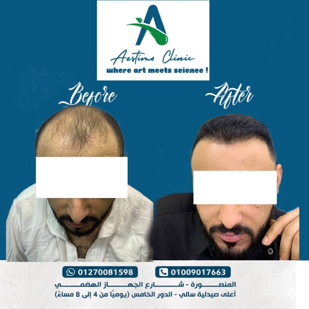 احد نتايج زراعه الشعر في مركز استيمو في المنصورة