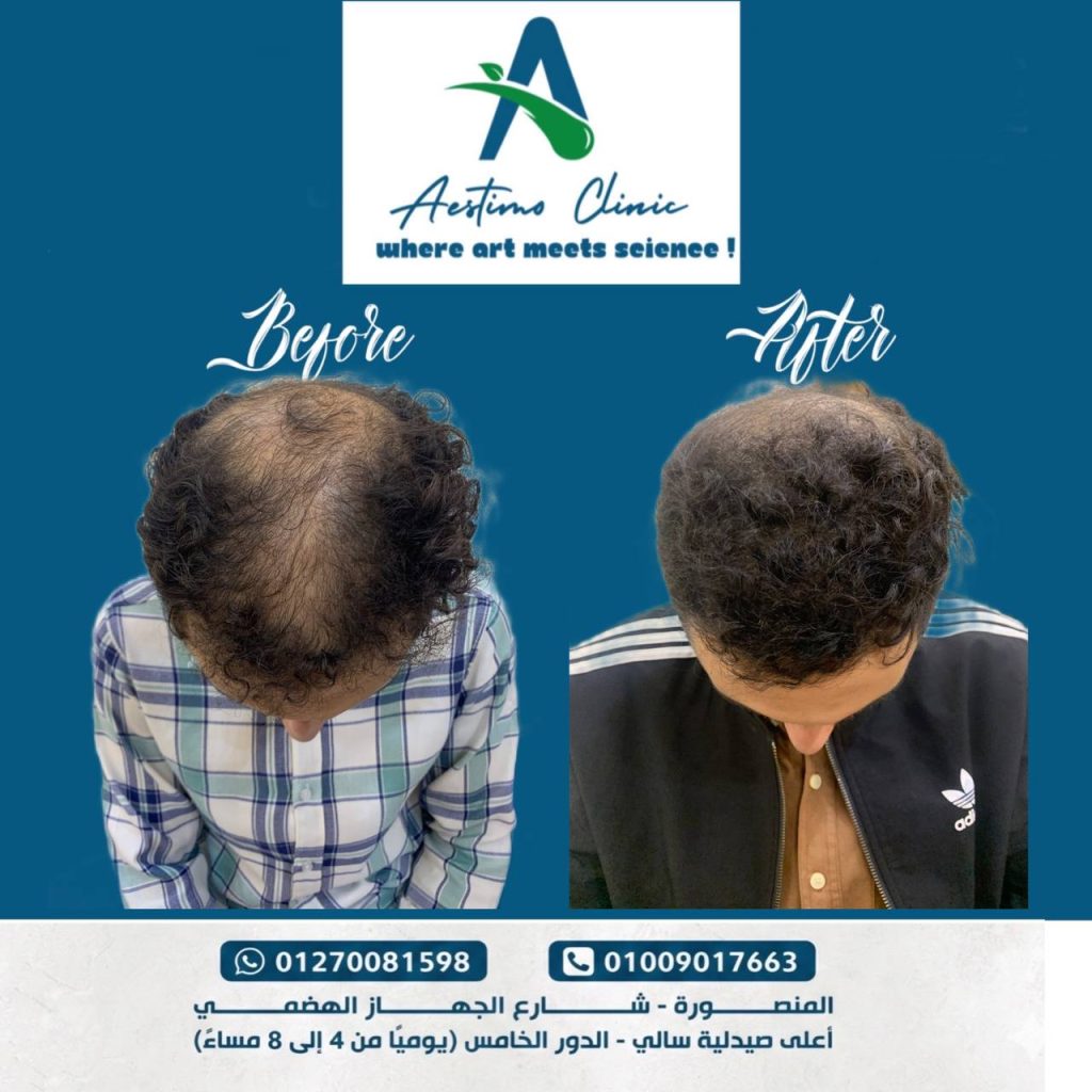 احد نتايج زراعه الشعر في مركز استيمو في المنصورة