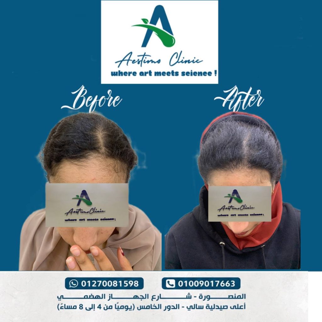 احد نتايج زراعه الشعر في مركز استيمو في المنصورة