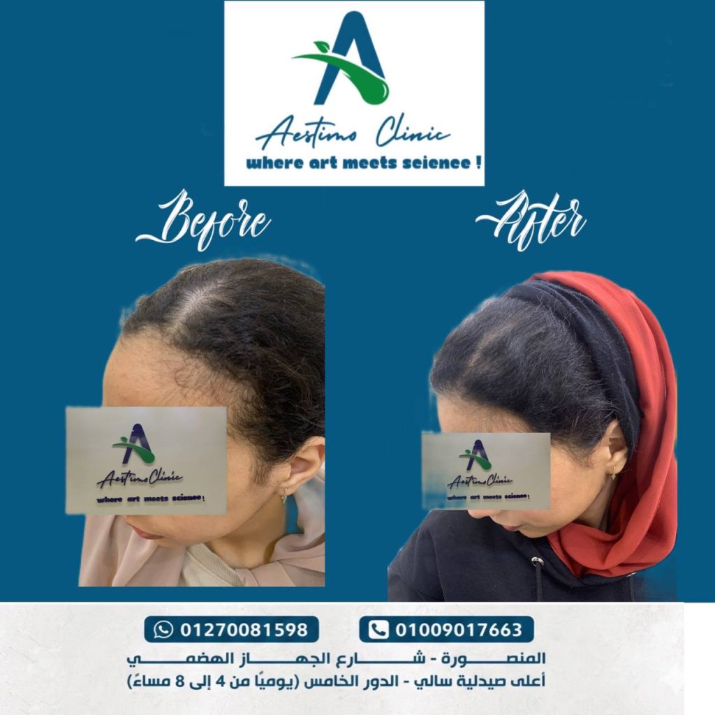 احد نتايج زراعه الشعر في مركز استيمو في المنصورة