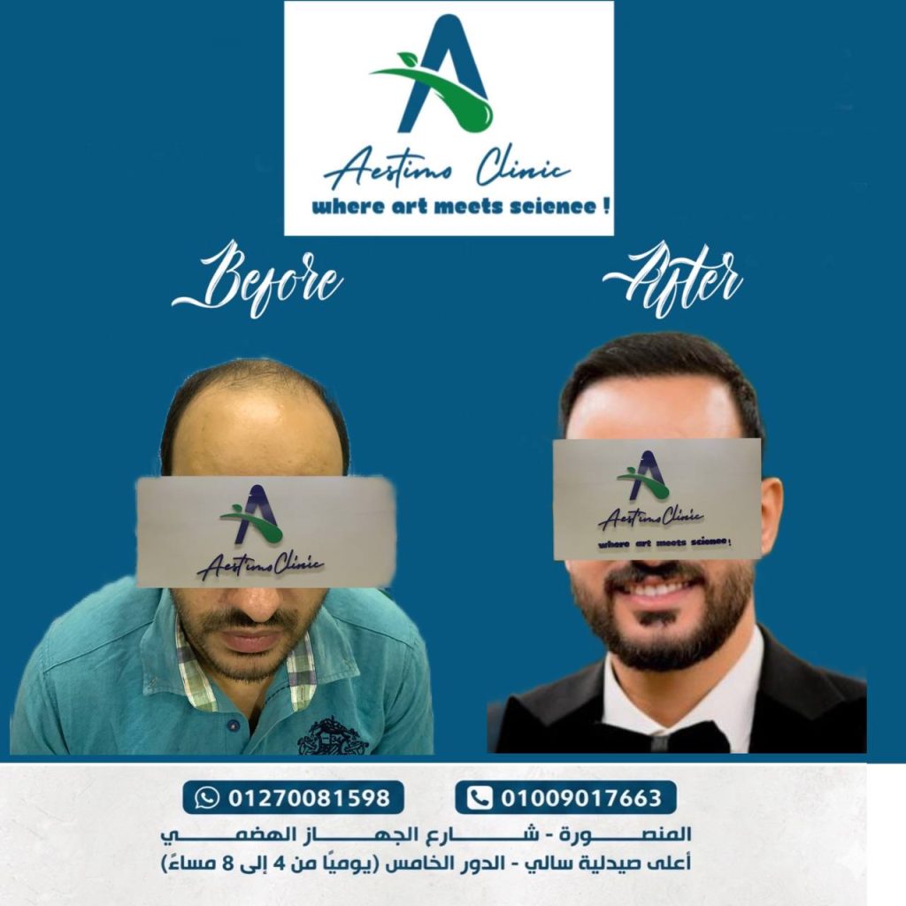 زراعة-شعر-قبل-وبعد-المنصورة-دكتور-طارق
