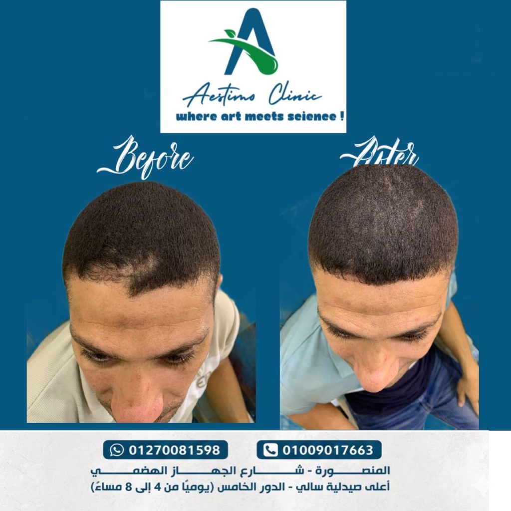 زراعة-شعر-قبل-وبعد-المنصورة-دكتور-طارق